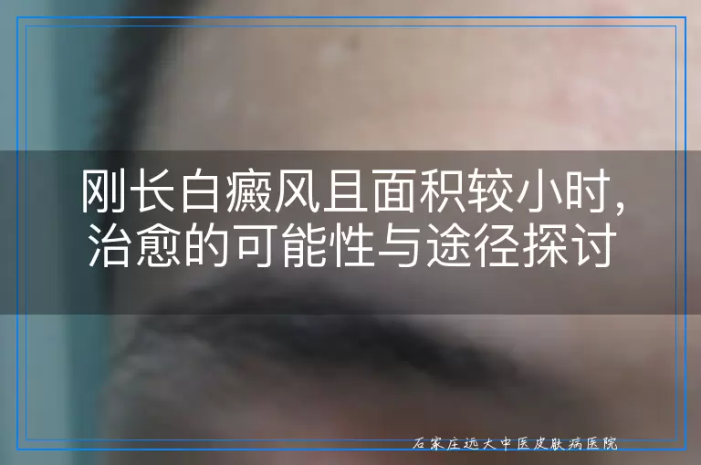 刚长白癜风且面积较小时，治愈的可能性与途径探讨