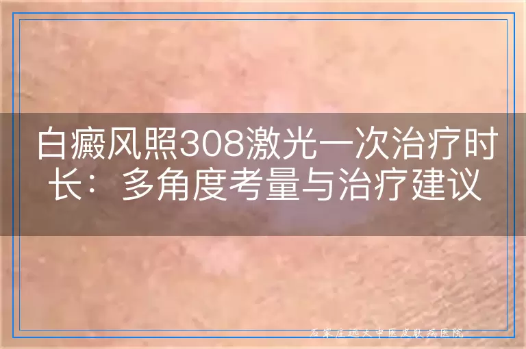 白癜风照308激光一次治疗时长：多角度考量与治疗建议