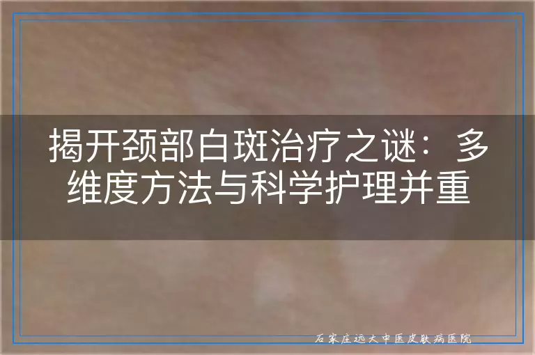 揭开颈部白斑治疗之谜：多维度方法与科学护理并重