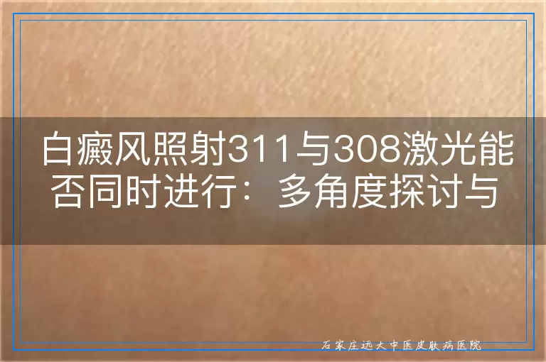 白癜风照射311与308激光能否同时进行：多角度探讨与考量
