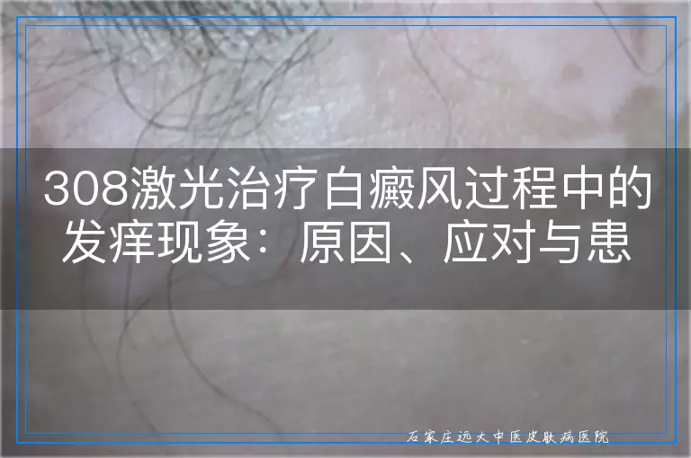 308激光治疗白癜风过程中的发痒现象：原因、应对与患者体验