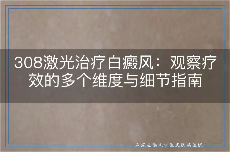 308激光治疗白癜风：观察疗效的多个维度与细节指南