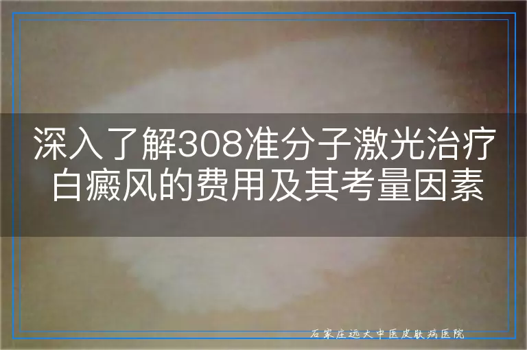 深入了解308准分子激光治疗白癜风的费用及其考量因素