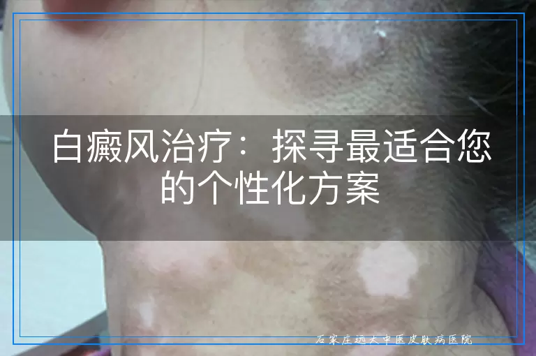 白癜风治疗：探寻最适合您的个性化方案