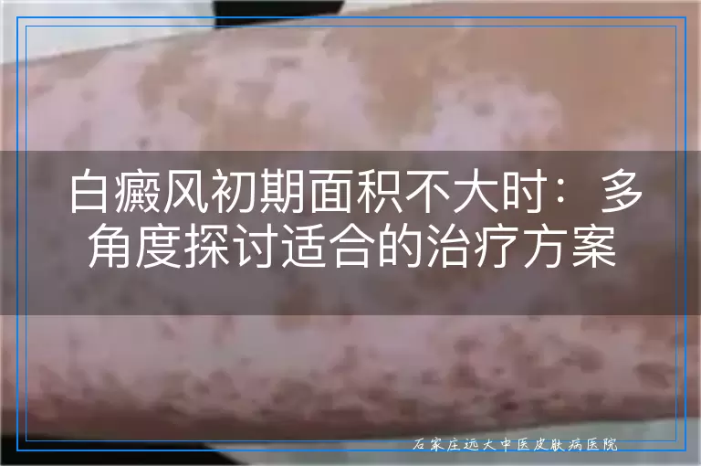 白癜风初期面积不大时：多角度探讨适合的治疗方案