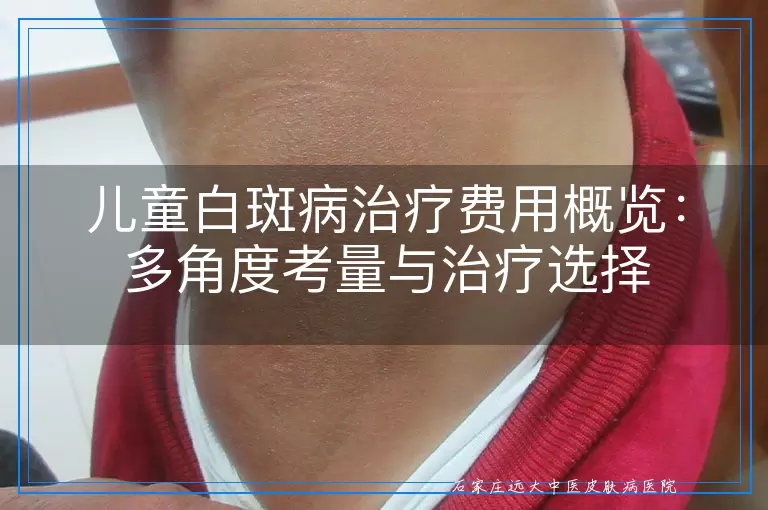 儿童白斑病治疗费用概览：多角度考量与治疗选择