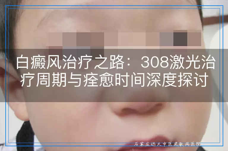 白癜风治疗之路：308激光治疗周期与痊愈时间深度探讨