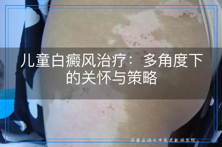 儿童白癜风治疗：多角度下的关怀与策略