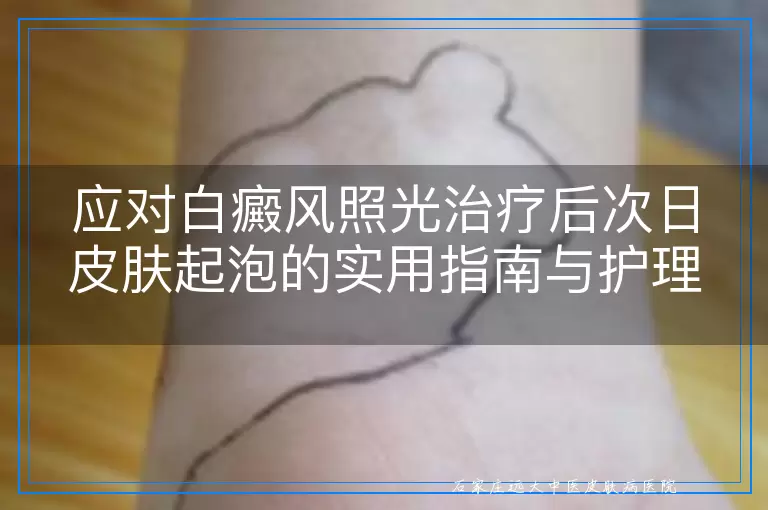 应对白癜风照光治疗后次日皮肤起泡的实用指南与护理措施