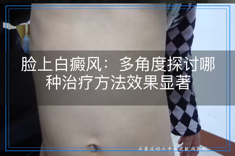 脸上白癜风：多角度探讨哪种治疗方法效果显著