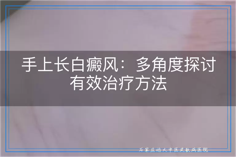 手上长白癜风：多角度探讨有效治疗方法