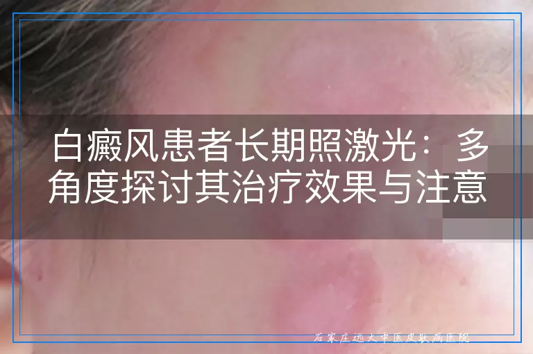 白癜风患者长期照激光：多角度探讨其治疗效果与注意事项
