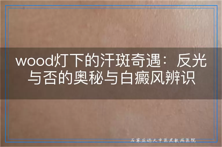 wood灯下的汗斑奇遇：反光与否的奥秘与白癜风辨识