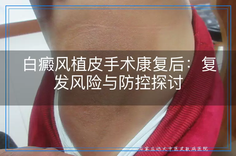 白癜风植皮手术康复后：复发风险与防控探讨