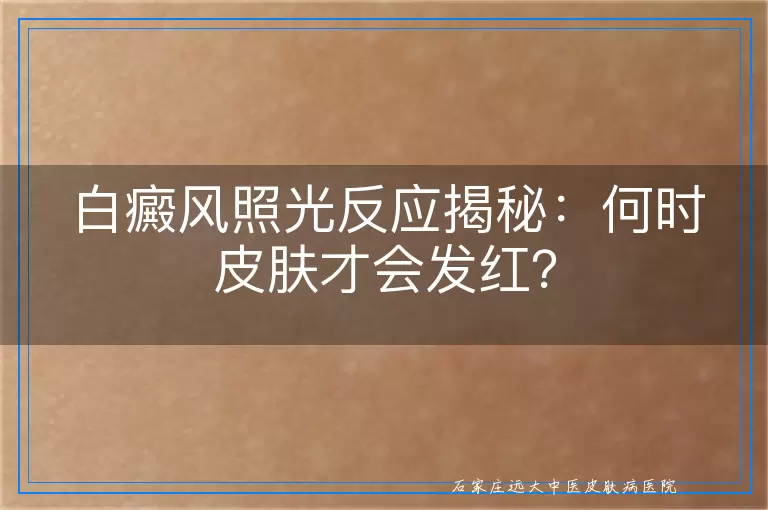 白癜风照光反应揭秘：何时皮肤才会发红？