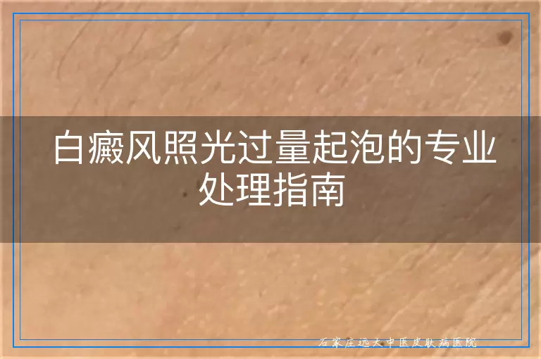 白癜风照光过量起泡的专业处理指南