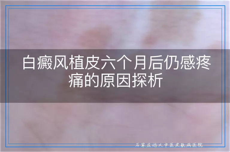 白癜风植皮六个月后仍感疼痛的原因探析