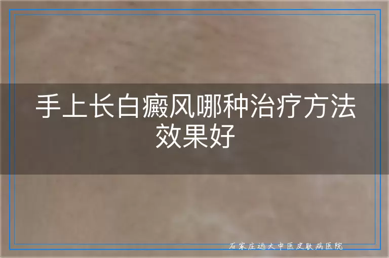 手上长白癜风哪种治疗方法效果好