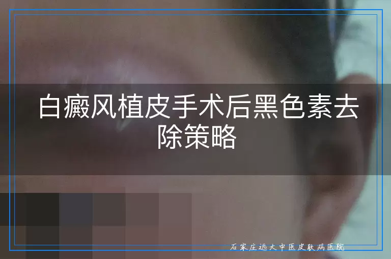 白癜风植皮手术后黑色素去除策略