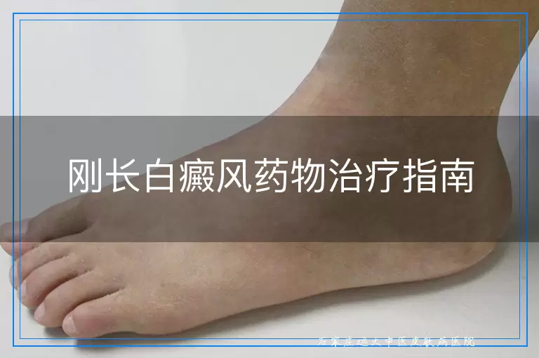 刚长白癜风药物治疗指南