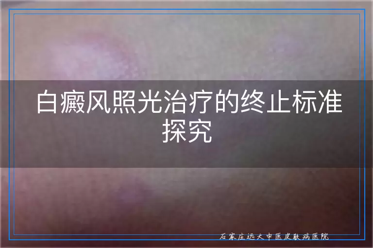 白癜风照光治疗的终止标准探究