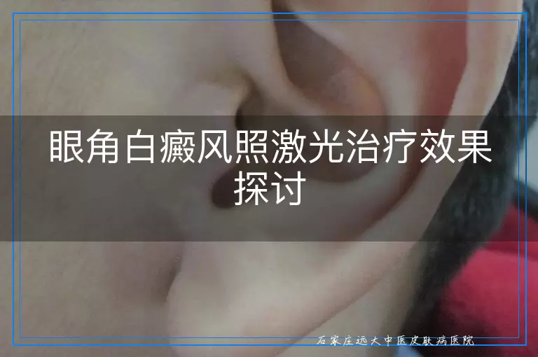眼角白癜风照激光治疗效果探讨