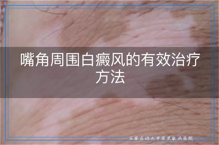 嘴角周围白癜风的有效治疗方法