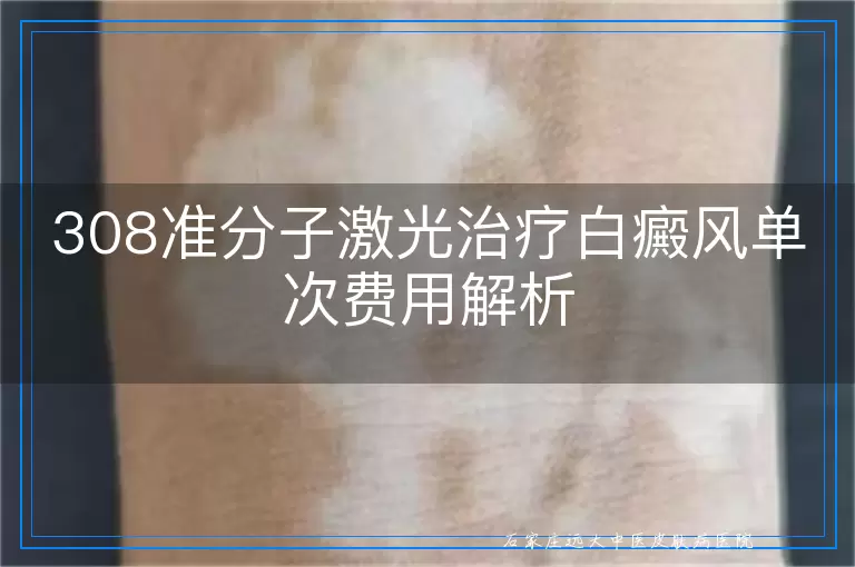 308准分子激光治疗白癜风单次费用解析