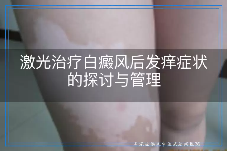 激光治疗白癜风后发痒症状的探讨与管理