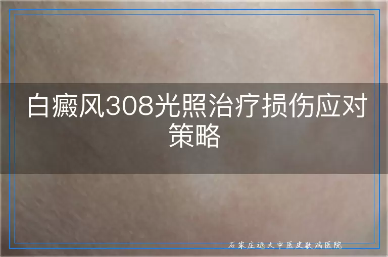 白癜风308光照治疗损伤应对策略
