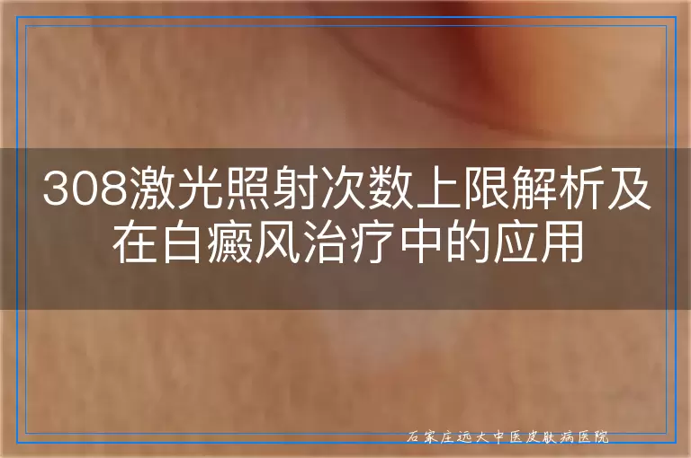 308激光照射次数上限解析及在白癜风治疗中的应用