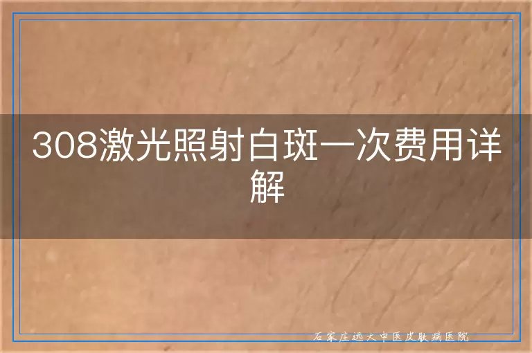308激光照射白斑一次费用详解