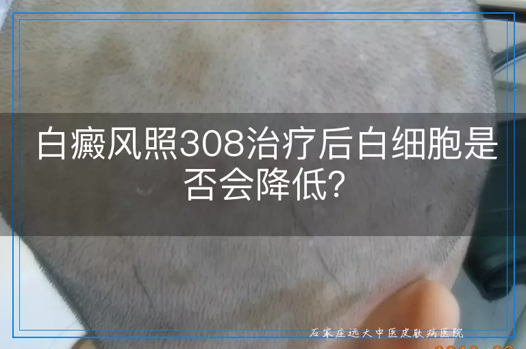 白癜风照308治疗后白细胞是否会降低?