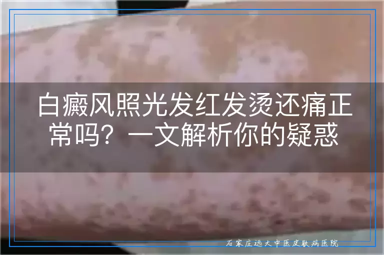 白癜风照光发红发烫还痛正常吗？一文解析你的疑惑