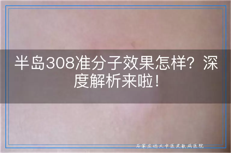 半岛308准分子效果怎样？深度解析来啦！