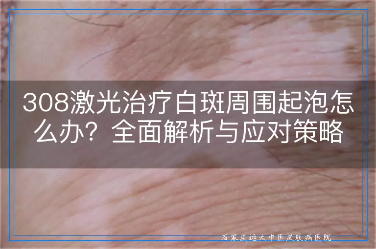 308激光治疗白斑周围起泡怎么办？全面解析与应对策略！