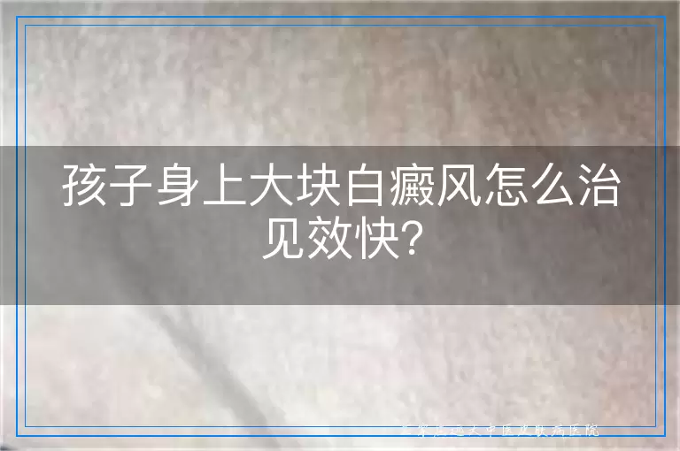 孩子身上大块白癜风怎么治见效快？