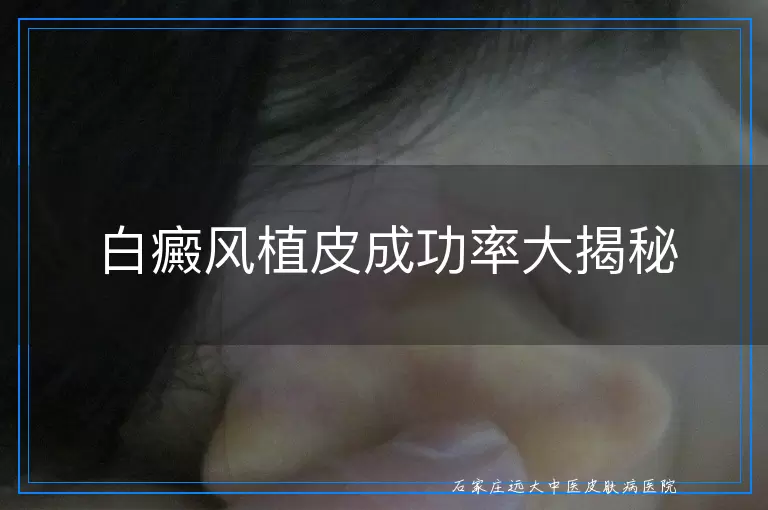 白癜风植皮成功率大揭秘