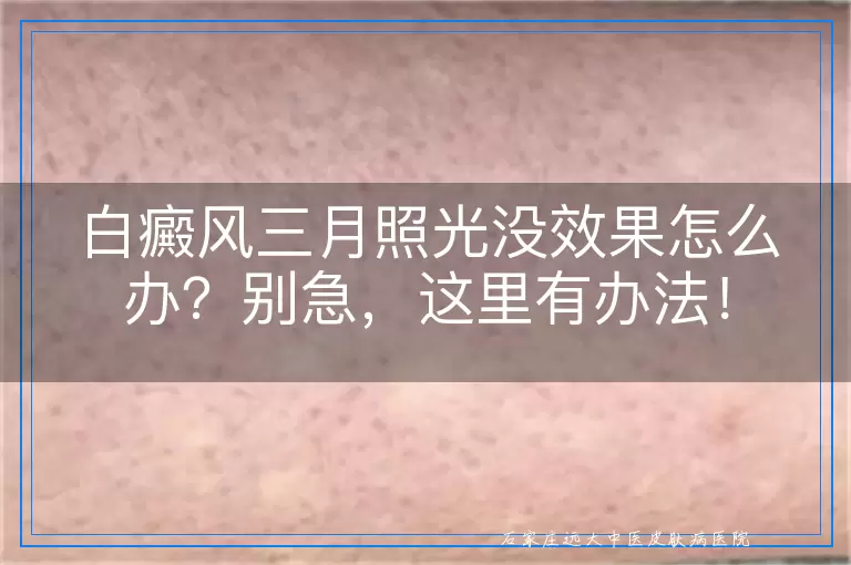 白癜风三月照光没效果怎么办？别急，这里有办法！