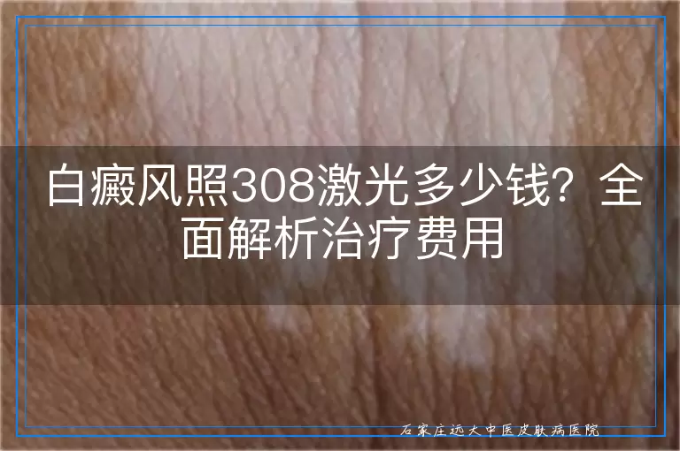白癜风照308激光多少钱？全面解析治疗费用