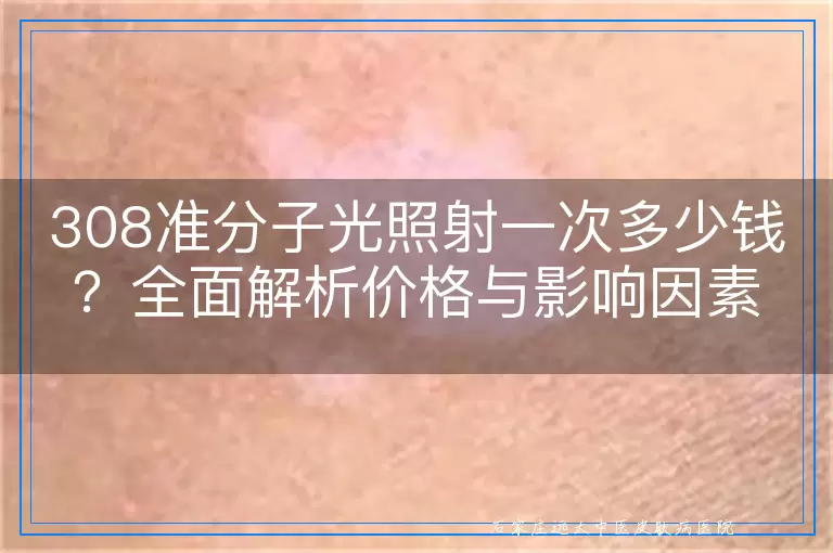 308准分子光照射一次多少钱？全面解析价格与影响因素