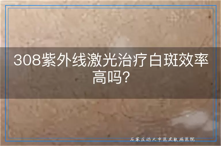 308紫外线激光治疗白斑效率高吗？