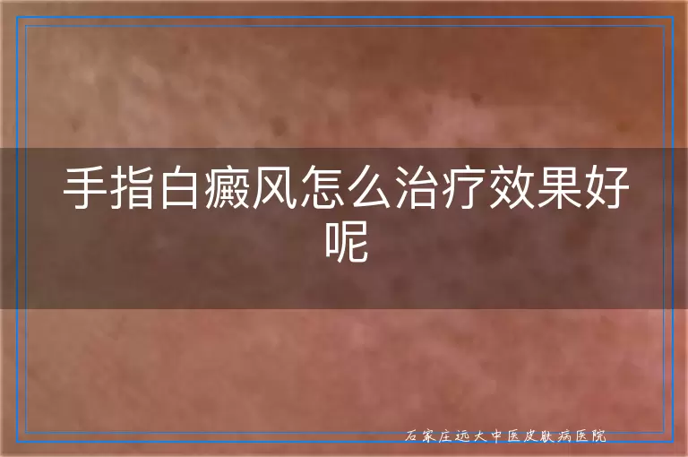 手指白癜风怎么治疗效果好呢
