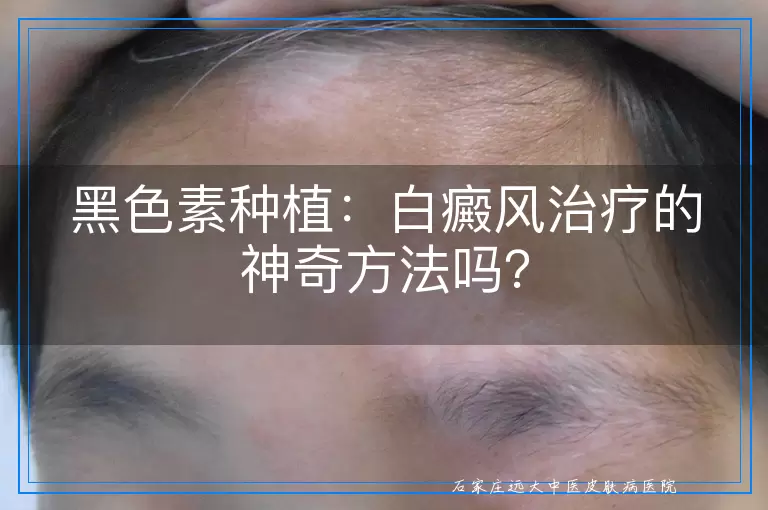 黑色素种植：白癜风治疗的神奇方法吗？