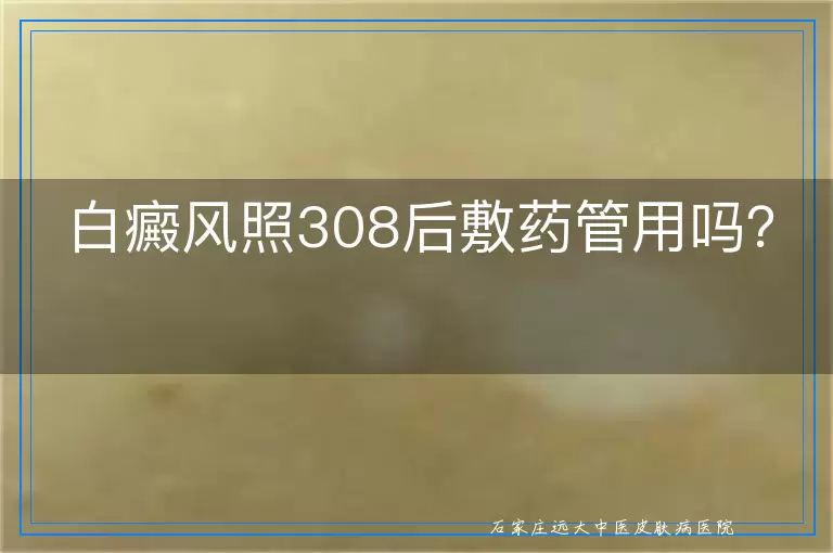 白癜风照308后敷药管用吗？
