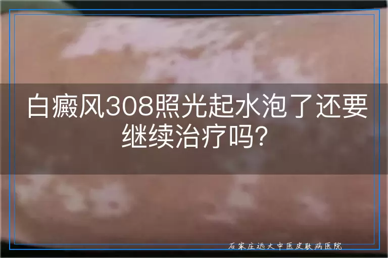 白癜风308照光起水泡了还要继续治疗吗？
