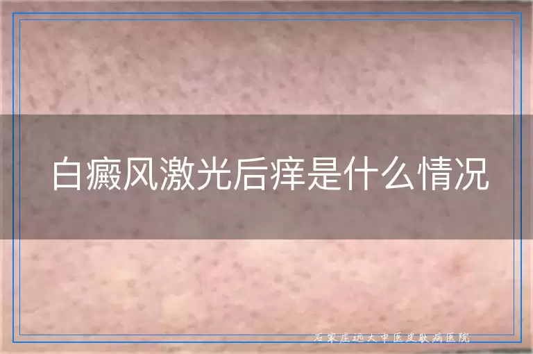白癜风激光后痒是什么情况