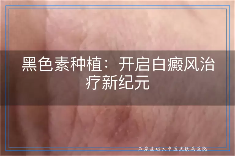 黑色素种植：开启白癜风治疗新纪元
