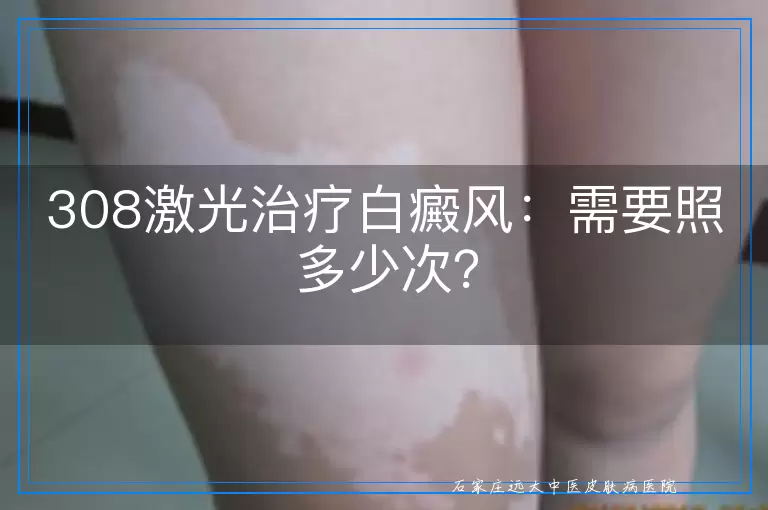 308激光治疗白癜风：需要照多少次？