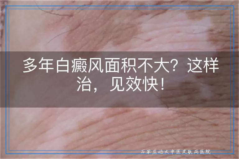 多年白癜风面积不大？这样治，见效快！